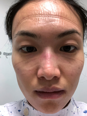 曾慧通宵夜班后，脱下口罩的样子，让人心疼。